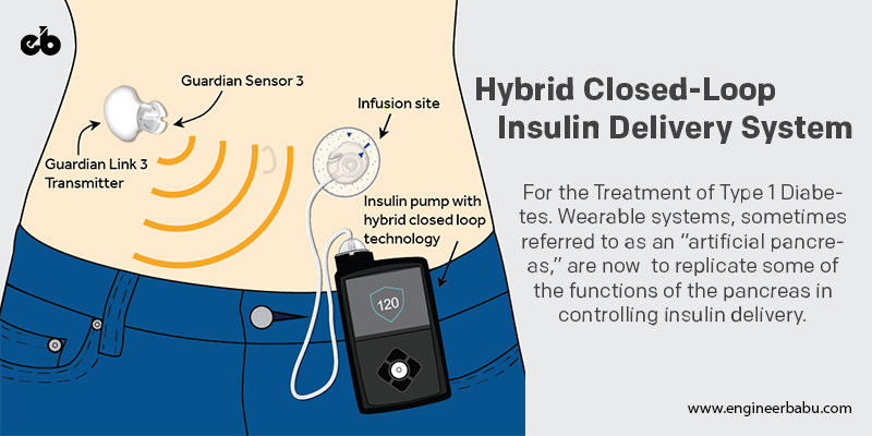 Hybrid Closed-Loop Insulin Delivery System